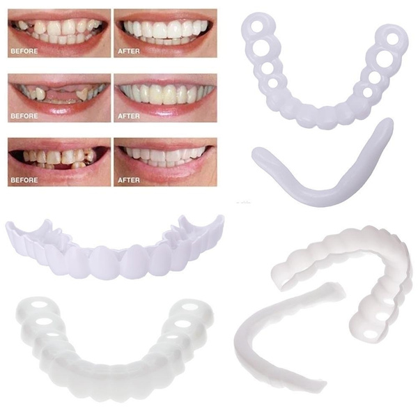 Veneers: Upper & Lower with NP Attachment