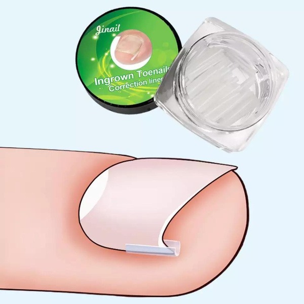 Ingrown Toenail Correction Braces (10 Pack)