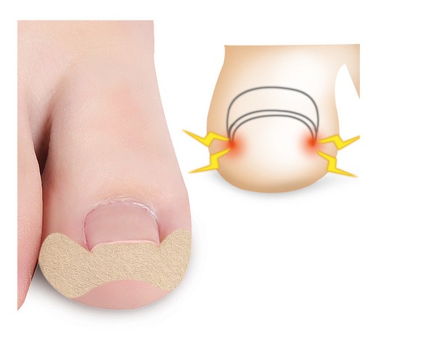 Ingrown Toenail Correction Patches: 6-Pack Treatment Kit