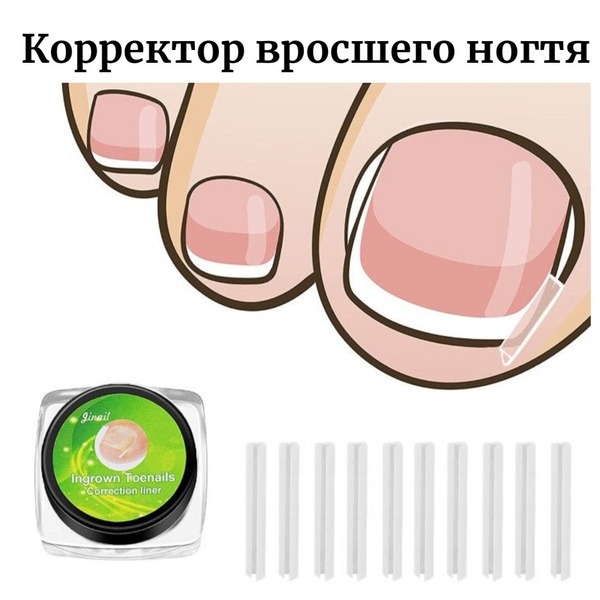 Ingrown Toenail Corrector Pads (10 Pack)