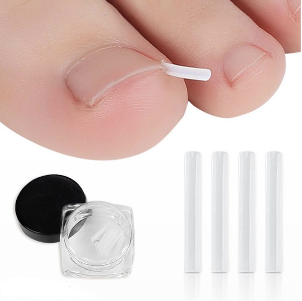 Ingrown Toenail Corrector Pads (10 Pack)