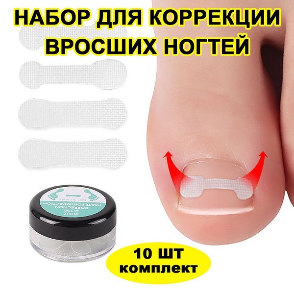 Ingrown Toenail Correction Tape - 10 Pack