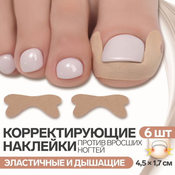 Ingrown Toenail Stickers (6 Pack) - Beige, 4.5 x 1.7 cm