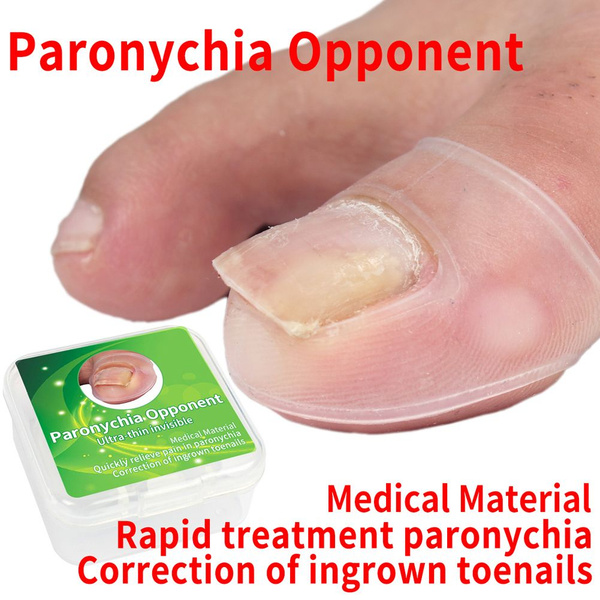 Ingrown Toenail Corrector