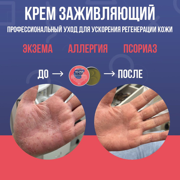 SOS Hand Cream: Relieves Dry, Itchy Skin
