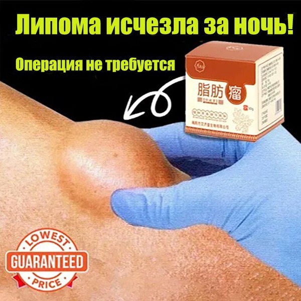 Thyroid Lipoma Cream: Reduce Subcutaneous Swelling & Cellulite (30g)