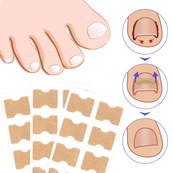 Ingrown Toenail Treatment