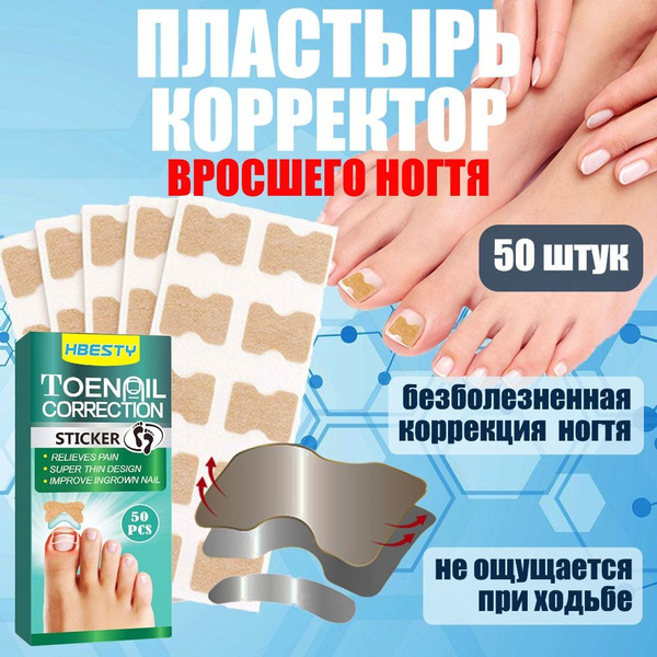 Ingrown Toenail Corrector Patches (50 Count) – Painless Relief & Treatment
