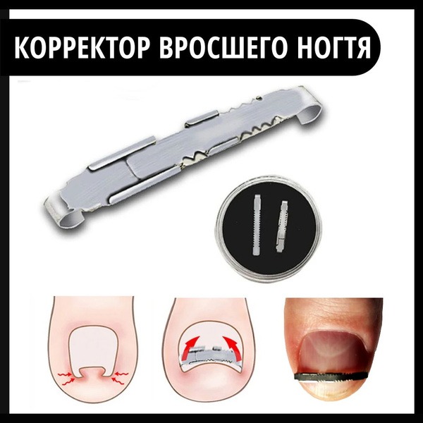 Ingrown Toenail Corrector and Straightener