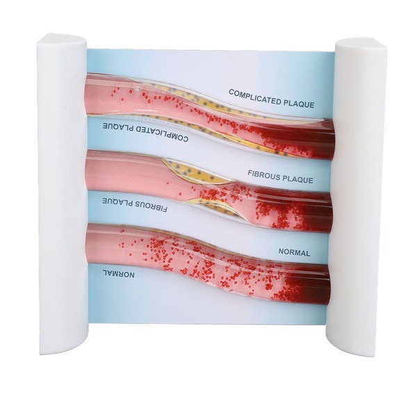 LDL Lipoprotein Blood Vessel Model for Medical Research