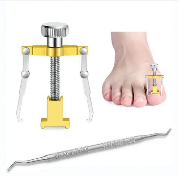 Ingrown Toenail Correction Kit: Home Treatment for Pain Relief