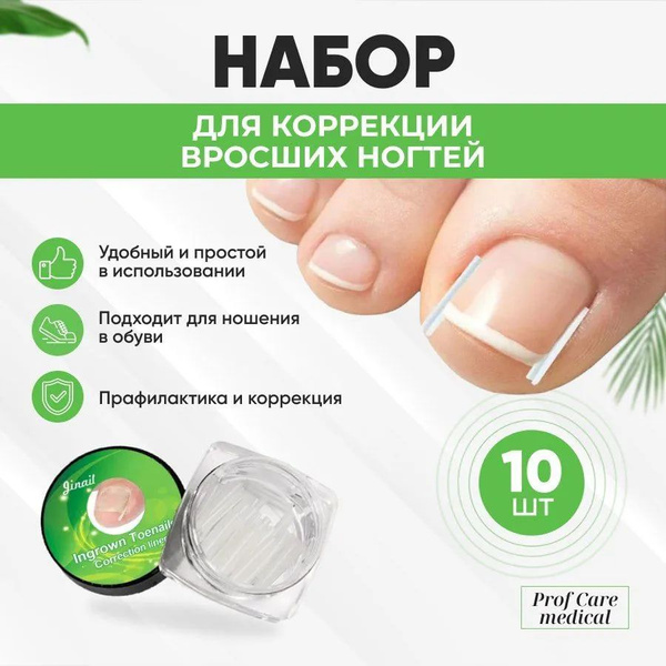 Ingrown Toenail Correction Inserts 10 Pcs / Ingrown Nail Corrector