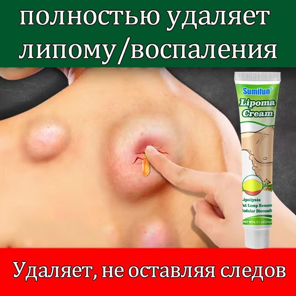 Lipoma Removal Cream: Reduce Fat Deposits & Skin Lumps (20g)
