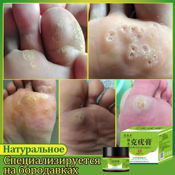 Wart & Callus Removal Cream with Celandine - 20g
