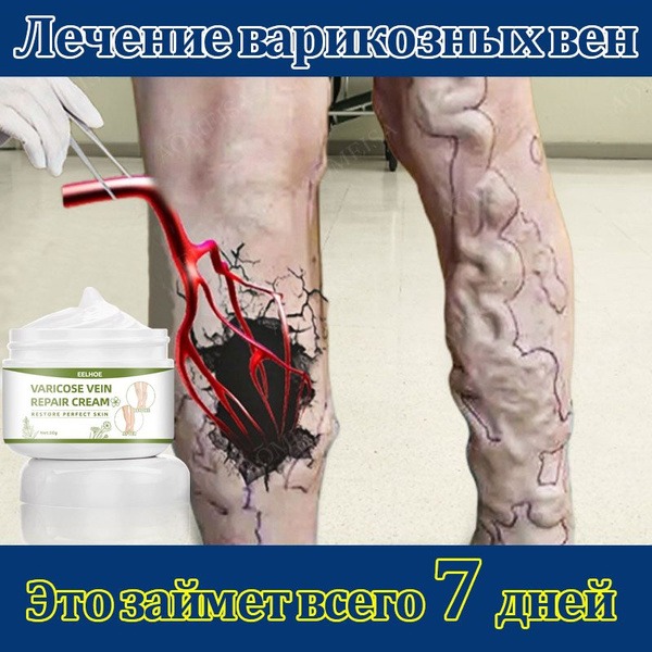 Varicose Veins Cream: Reduce Swelling, Fatigue & Leg Heaviness (50ml)