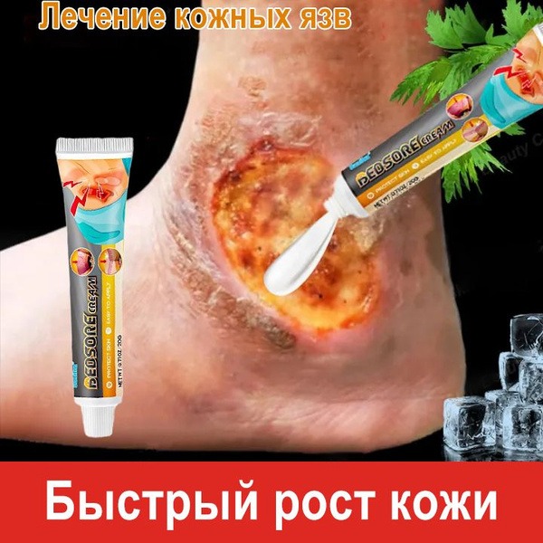Pressure Sore Treatment Gel: 20g Nanyu