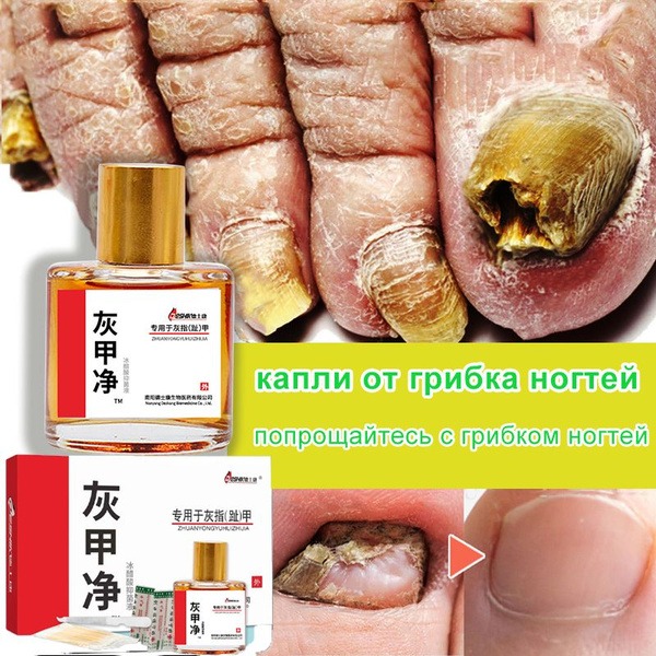 25ml Toenail Fungus Treatment: Restore Healthy Nails