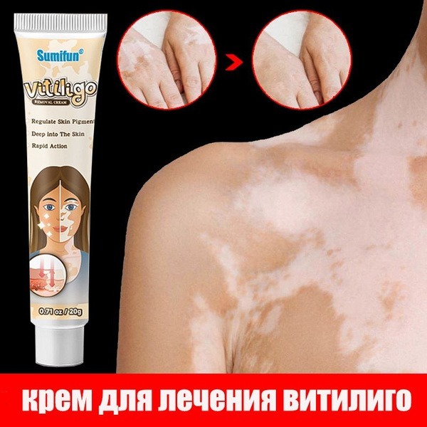 Vitiligo Repair Cream: Fast Skin Treatment with Natural Chinese Herbs (20g)