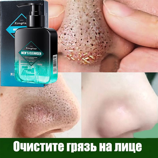 Acne & Blackhead Fighting Face Wash Gel for Men (160g)