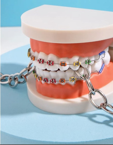 Metal Veneer Braces