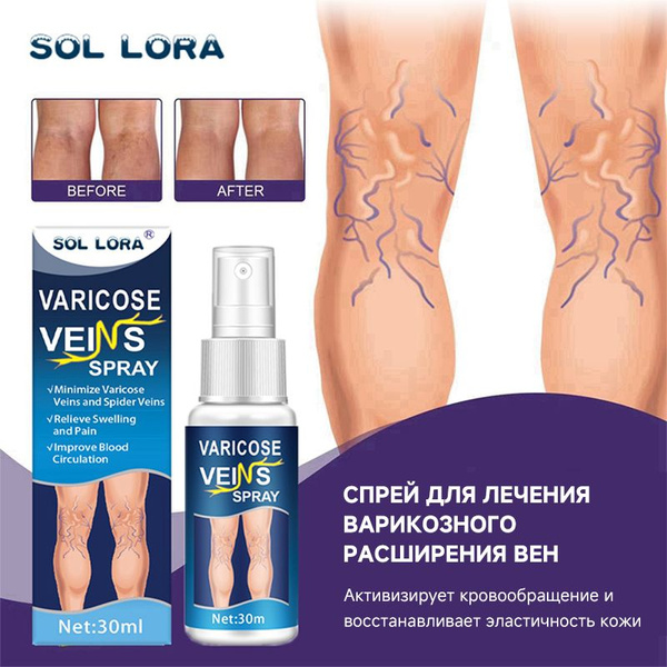 Varicose Veins Spray: Relieve Leg Pain, Swelling & Inflammation (30ml)