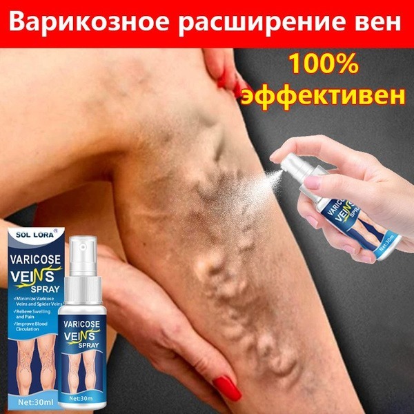 Varicose Vein Spray: 30ml, Smooths Veins, Soothes Skin, Reduces Bulging