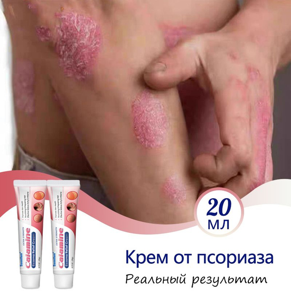 Sumifun Natural Eczema, Dermatitis, Psoriasis & Acne Cream (20ml)