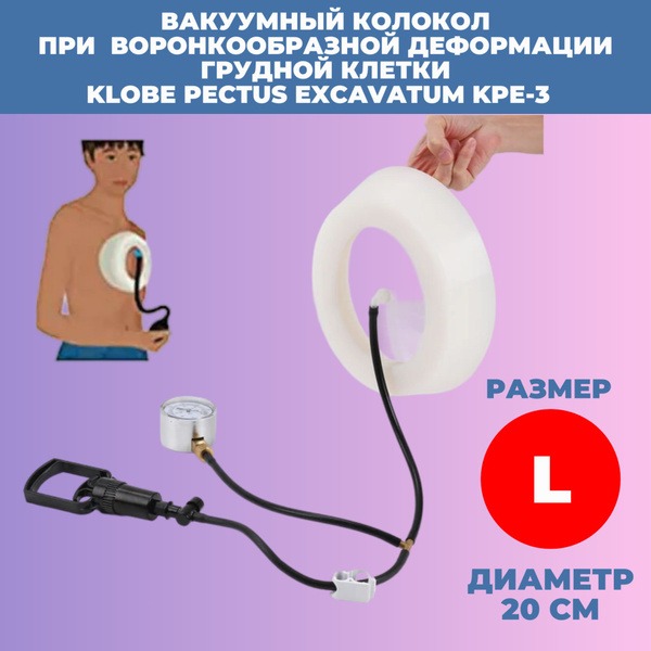 Pectus Excavatum Vacuum Bell: KLOBE KPE-3 Orthotic Treatment