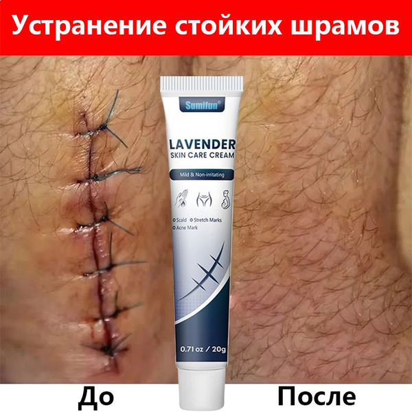 Scar Removal Cream 20g: Reduces Scars & Smooths Skin