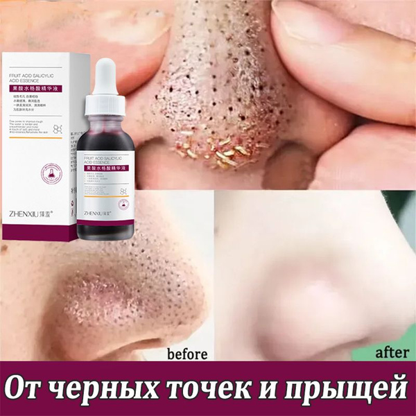 Salicylic & Fruit Acid Face Serum (30ml): Pore Minimizing, Acne Treatment & Hydration