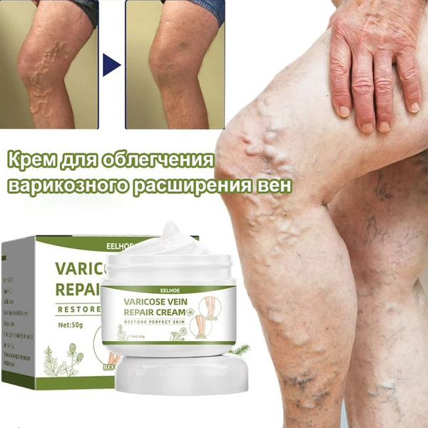 Varicose Veins Cream: Effective Relief for Swelling, Pain & Fatigue (50g)