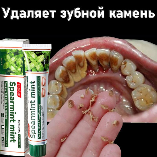 Teeth Whitening Toothpaste: Removes Tartar, Whitens Yellow Teeth, Freshens Breath (100g)