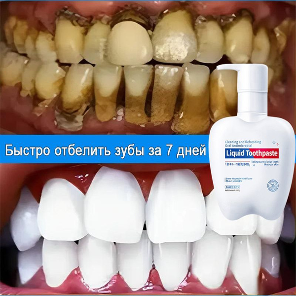 Whitening Toothpaste: Remove Stains, Bad Breath & Prevent Cavities (200g)