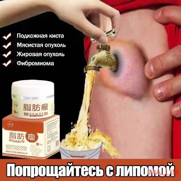Lipoma Cream 30g: Reduce Swelling & Prevent Recurrence