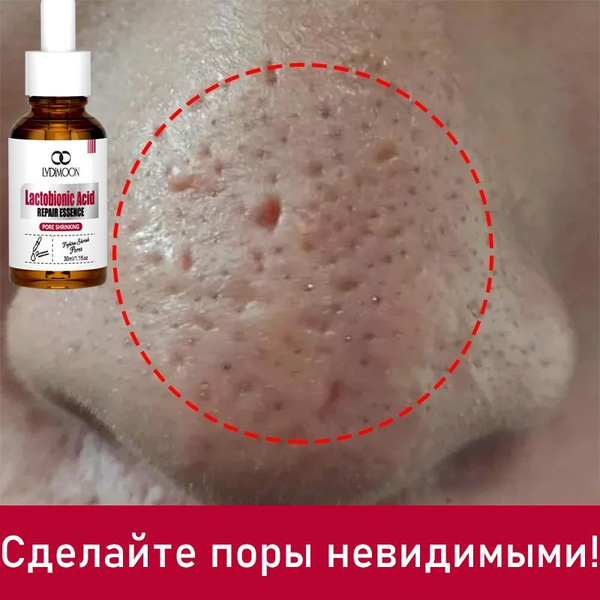 Fruit Acid Face Serum: Pore Minimizing & Acne Clearing (30ml)