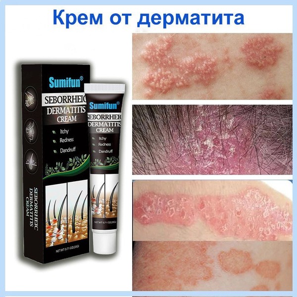Seborrheic Dermatitis Cream: Psoriasis, Eczema & Itch Relief (20g)