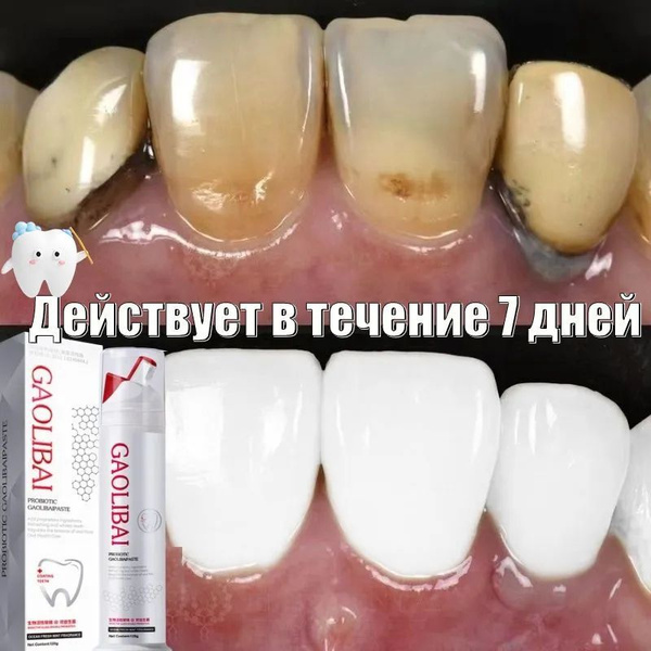 Professional Whitening Toothpaste with Probiotics: 120g, Gentle Whitening, Anti-Cavity, Tartar Control, Gum Repair