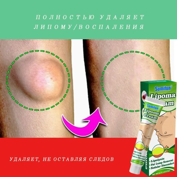 Lipoma Removal Cream: Eliminate Fat Deposits & Subcutaneous Lumps (20g)