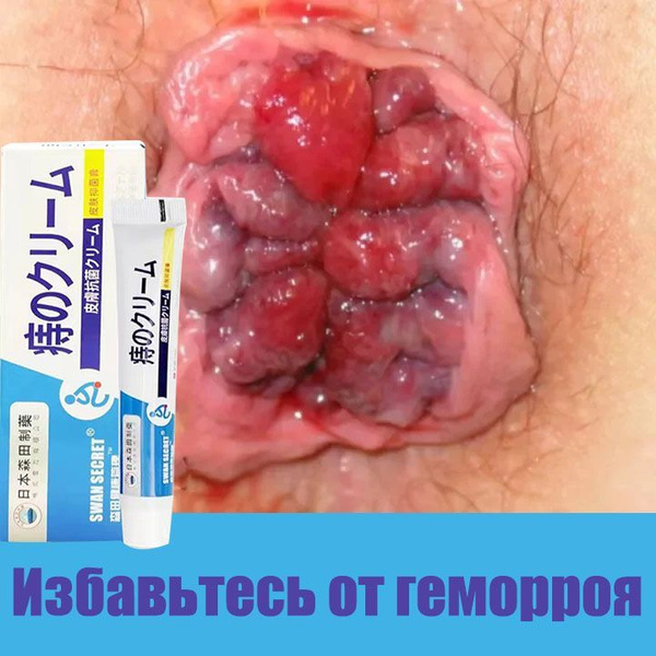 Hemorrhoid Cream: Anti-inflammatory, Bleeding, Pain Relief (Internal & External) - 20g Tube