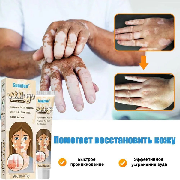 Vitiligo Treatment Cream: Restore Skin Pigmentation