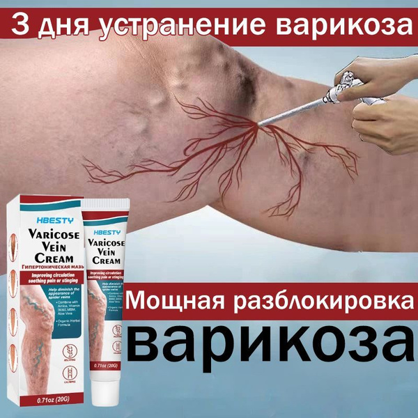Cooling Varicose Vein Gel: Treats Spider Veins, Thrombosis, Swelling & Tired Legs (20g)