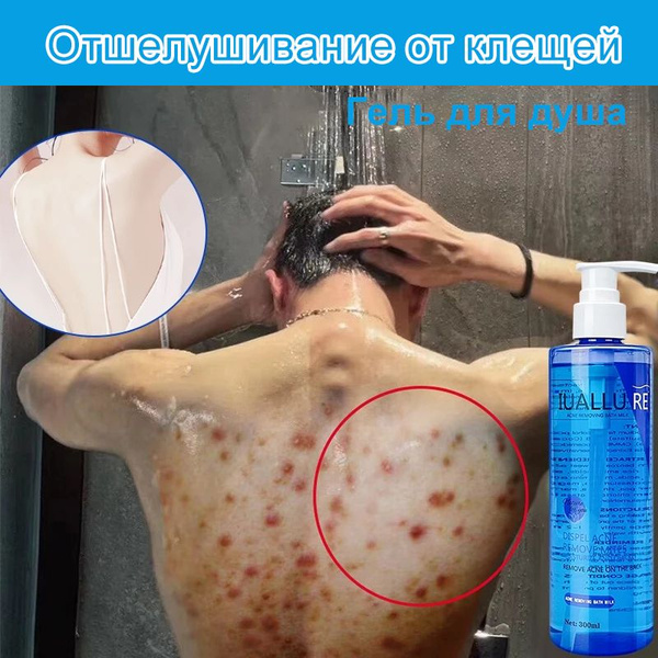 Acne Body Wash for Clear Skin: Antibacterial & Purifying Gel (300ml)