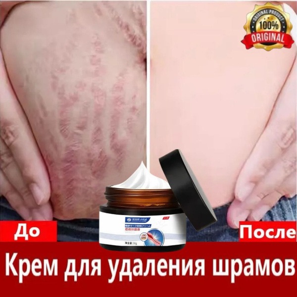 Scar Removal Cream: Antibacterial & Effective on Stubborn Scars