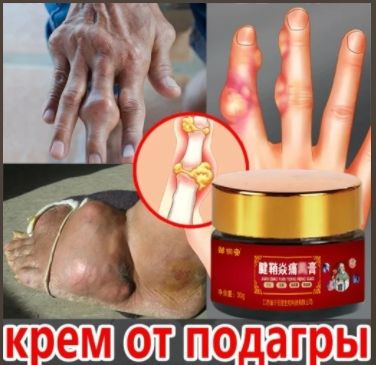 Gout Cream 30g: Reduce Joint Pain, Swelling, & Uric Acid