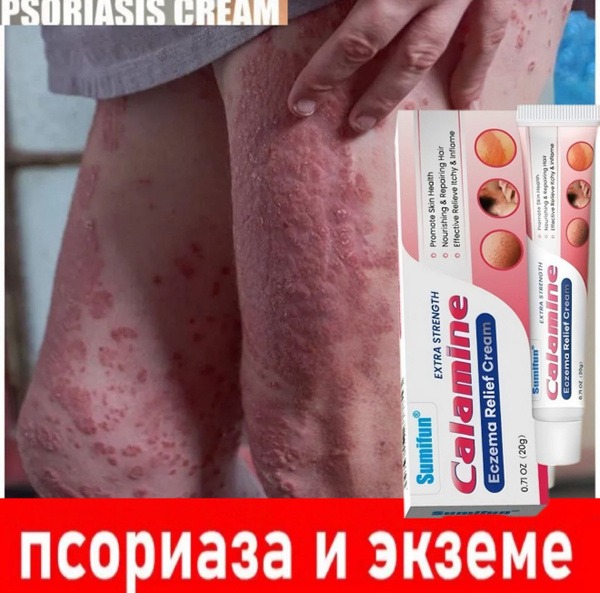 Psoriasis & Eczema Cream: 20g Anti-Fungal Itch Relief for Men