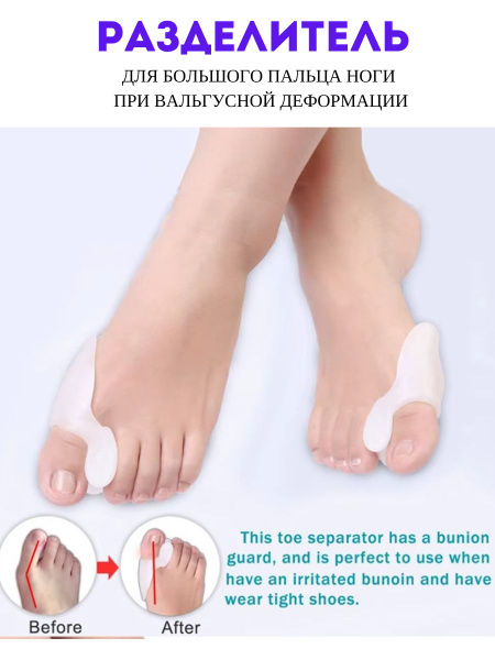 Bunion Corrector: Valgus Splint for Big Toe