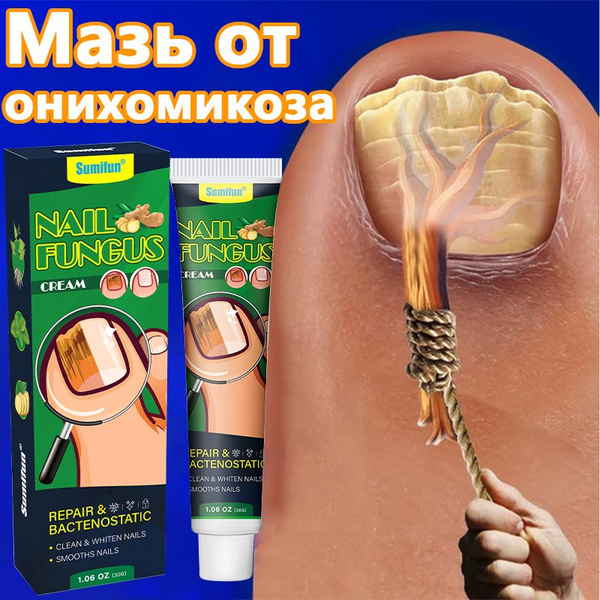 Onychomycosis Cream 30g: Painless Treatment for Thick, Yellow & Gray Toenails