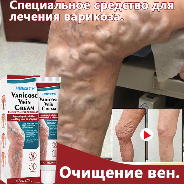 Varicose Vein Cream 20ml: Reduce Leg Fatigue & Improve Circulation