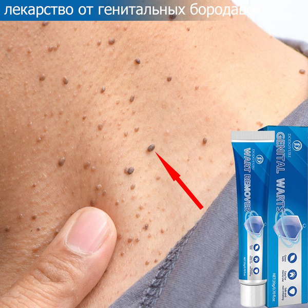 Wart & Mole Removal Cream: Natural, Safe & Effective Treatment (20g)