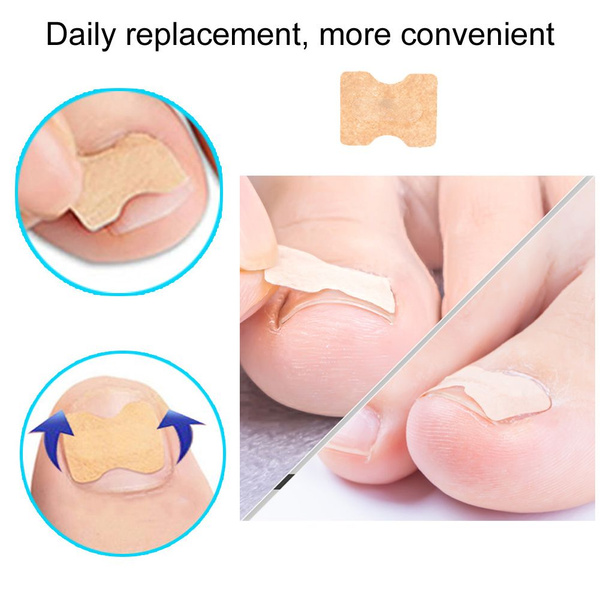 Self-Adhesive Orthotic Nail Stickers
